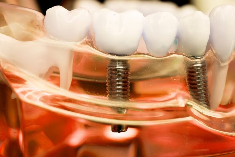 השתלות שיניים למחוסרי עצם