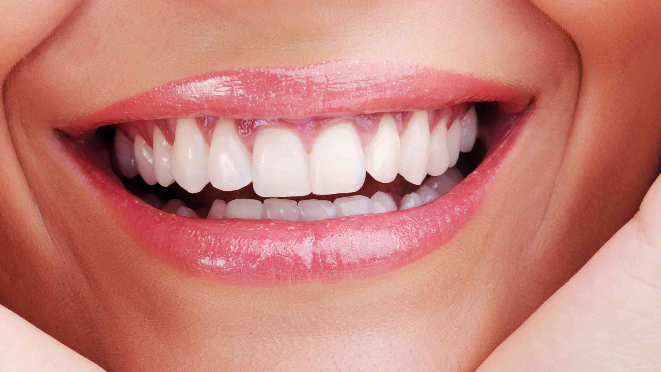ציפוי לשיניים קדמיות