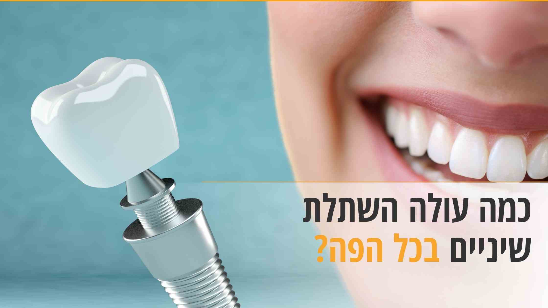 כמה עולה השתלת שיניים בכל הפה