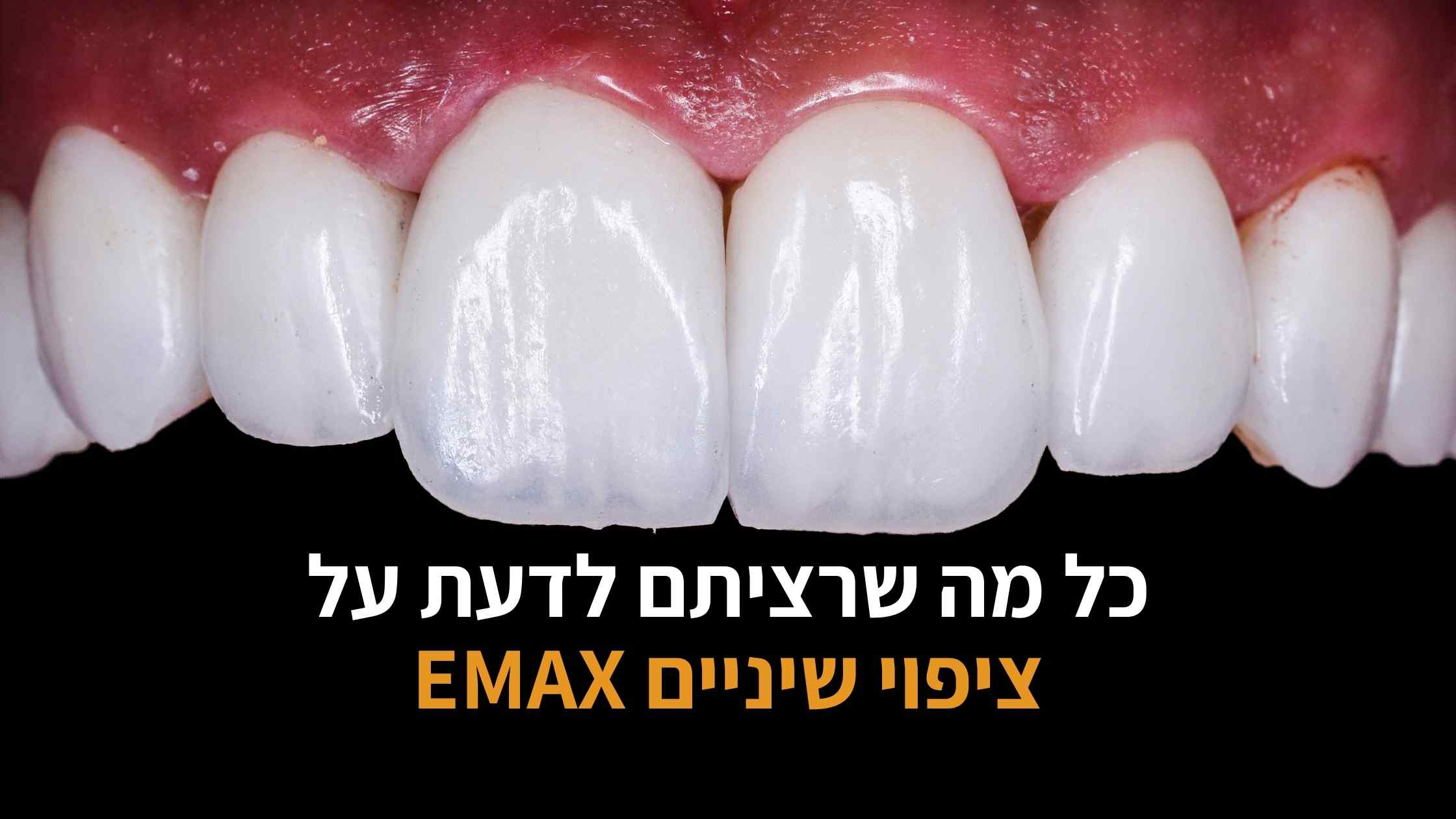 ציפויי שיניים איימקס EMAX