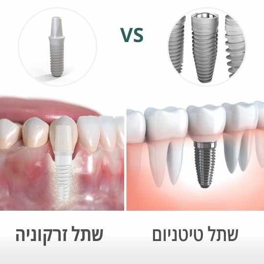 שתלי זירקוניה הדור החדש: ללא מתכת ובריא יותר לחניכיים 🦷| השתלות שיניים ...