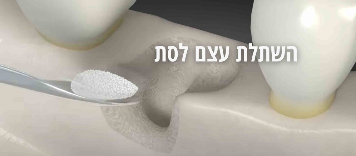 מתחת לפני השטח: מה חשוב לדעת על השתלת עצם לסת? 🦷 | השתלות שיניים GARA ...