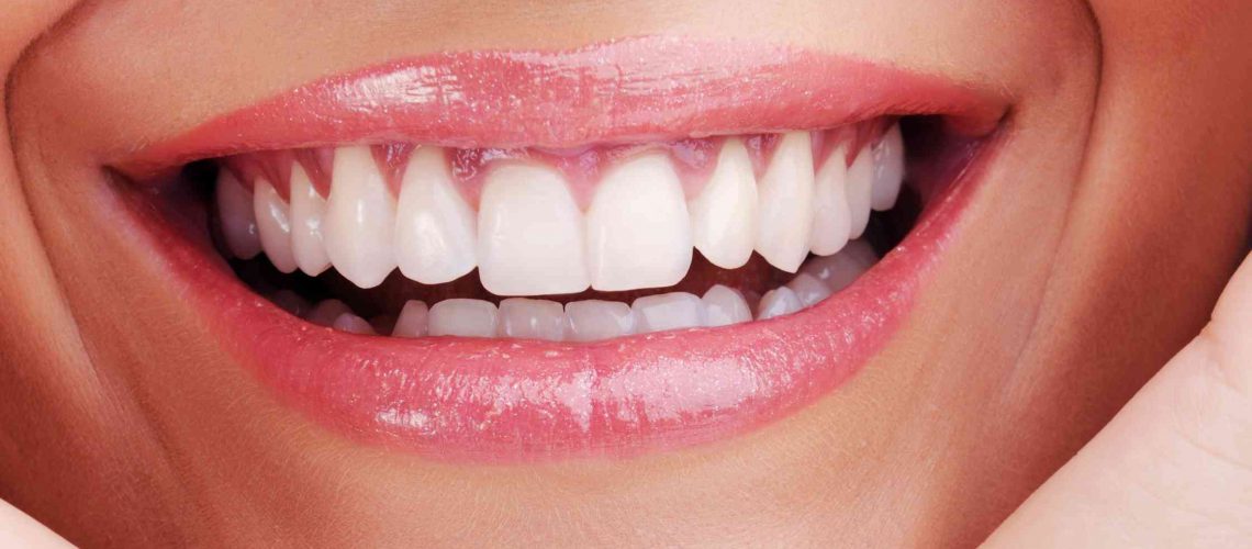 ציפוי לשיניים קדמיות